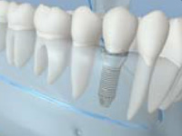 dental-implants-mini