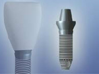 dental-implants