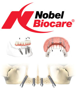 Nobel Biocare dental implants